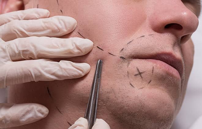 Consider these 5 facts while planning for a beard transplant