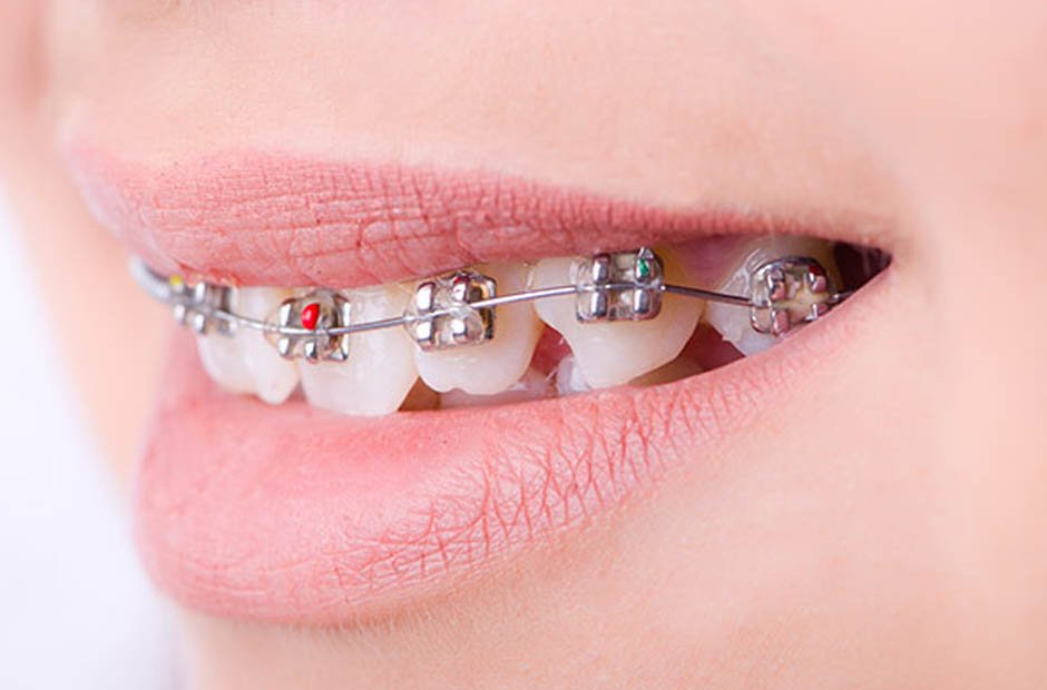 How Orthodontics Can Transform Your Smile